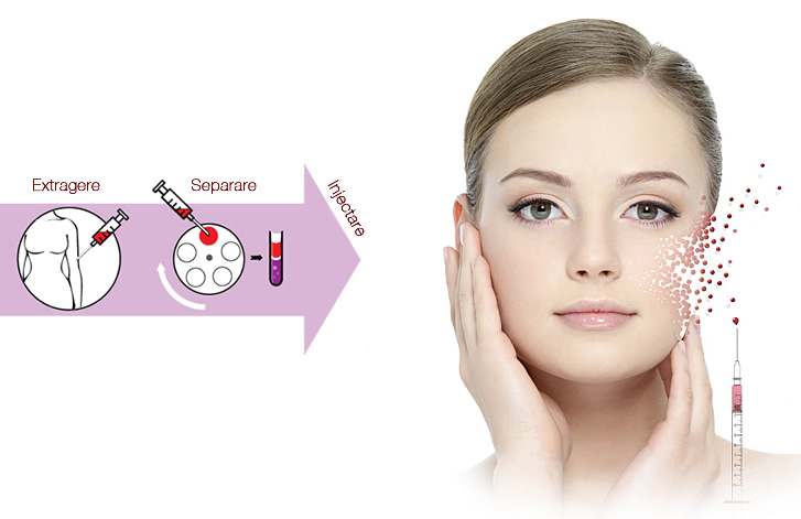 PRP (“platelet rich plasma”)- efect miraculous prin capacitatea de refacere a organismului uman